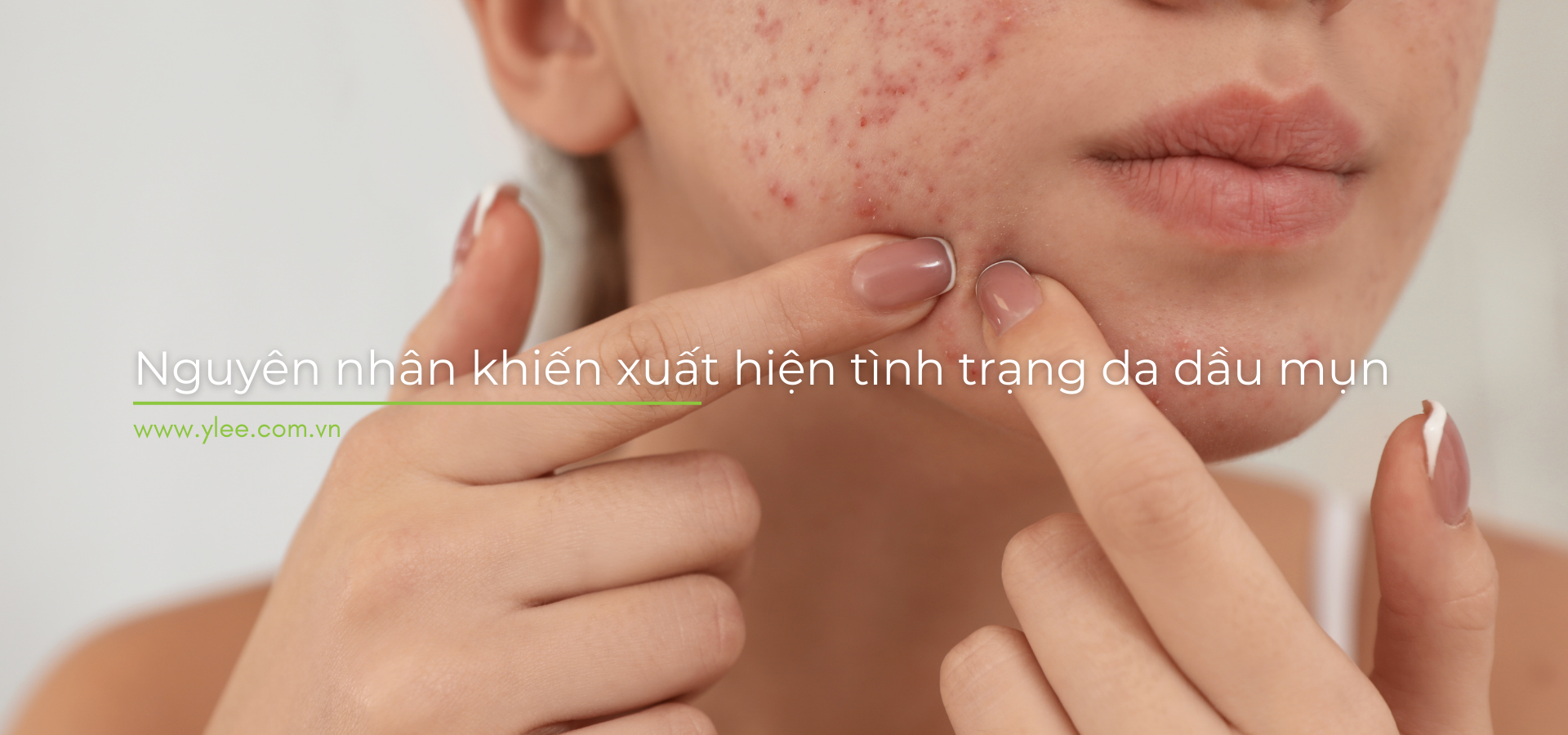 Cùng YLEE tìm hiểu nguyên nhân da dầu mụn