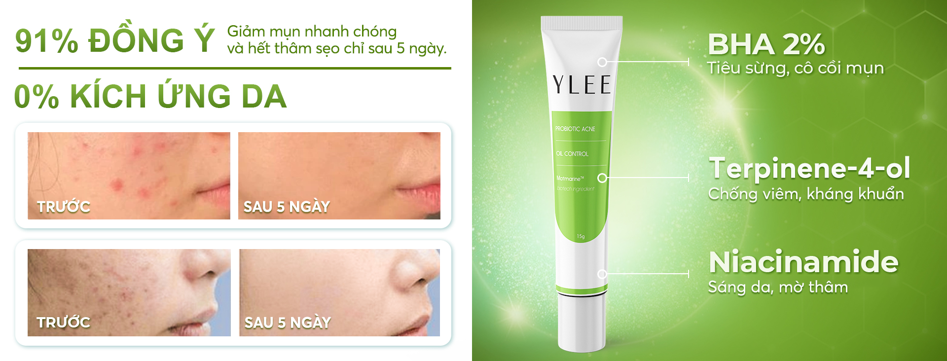 Gel bôi mụn Ylee giúp giảm thâm ngừa viêm